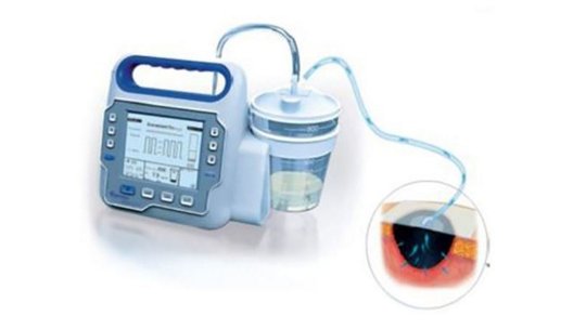 Medical device for eye fluid drainage, showing a pump connected to a close-up of an eye procedure.