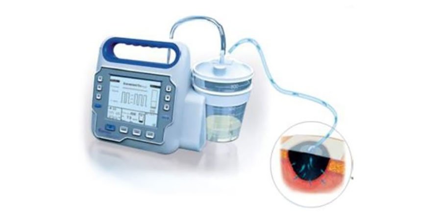 Medical device for eye fluid drainage, showing a pump connected to a close-up of an eye procedure.